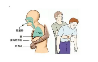 遇到異物卡住喉嚨，可采取海姆立克急救法。海姆立克急救法是科學解除氣道異物堵塞的急救方法，分為成人版操作和兒童版操作兩種急救方法(圖1)